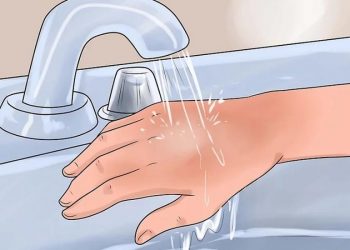 mơ về vết bỏng