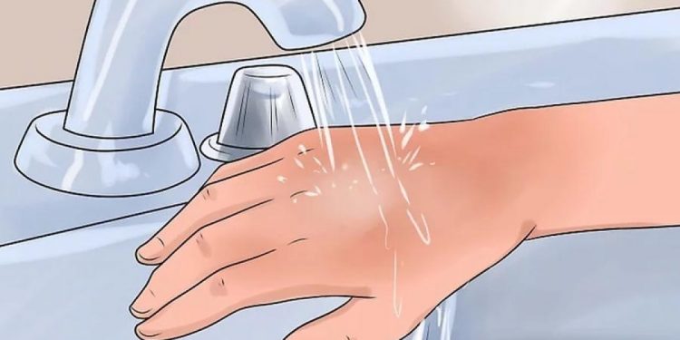 mơ về vết bỏng